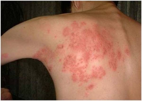 Cách chữa bệnh viêm da thần kinh hiệu quả nhất