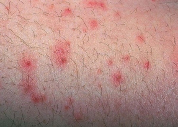 Cách chữa trị hiệu quả bệnh viêm da tụ cầu