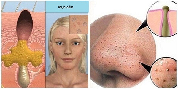 nguyen-nhan-gay-mun-cam