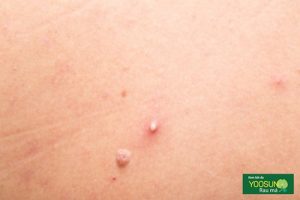 Cách trị mụn đầu trắng tại nhà