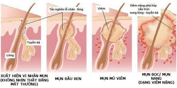 nguyen-nhan-gay-ra-tham-mun