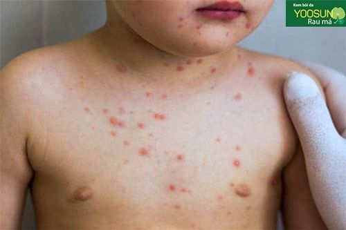 Bệnh viêm da nhiễm khuẩn ở trẻ em