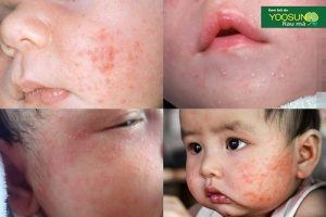 Mụn kê trên mặt trẻ sơ sinh