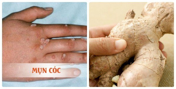 Cách trị mụn cóc an toàn, hiệu quả bằng các mẹo dân gian