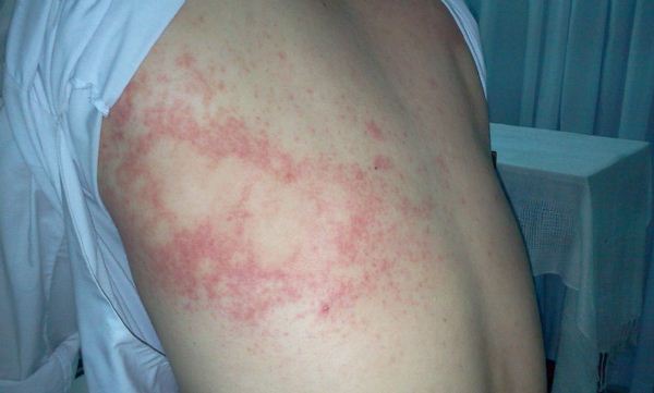 Da bị nổi mẩn đỏ không ngứa là bệnh gì, cách chữa trị ra sao?