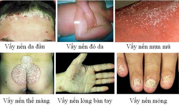 cac-the-lam-sang-cua-benh-vay-nen