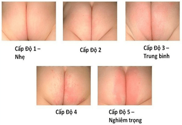 cap-do-ham-ta