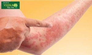 Cách trị rôm sảy tại nhà