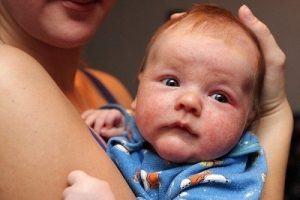 Trẻ bị chàm sữa tắm lá gì nhanh khỏi