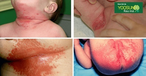 Bệnh hăm da ở trẻ em