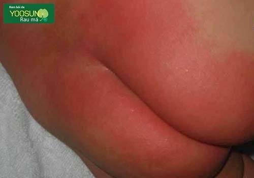 Cách trị hăm mông cho trẻ sơ sinh