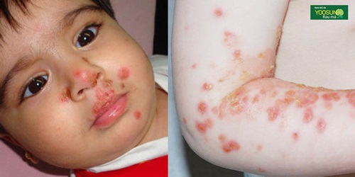 Trẻ bi viêm da nhiễm khuẩn