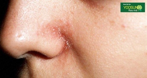 Cách chữa viêm da tiết bã nhờn ở mặt