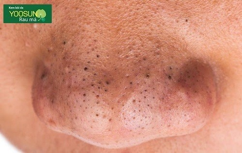 Tại sao có mụn đầu đen trên mũi? 10 Cách trị mụn đầu đen ở mũi