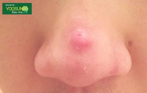 Mụn bọc ở mũi là bệnh gì? Nguyên nhân và cách trị mụn bọc ở mũi