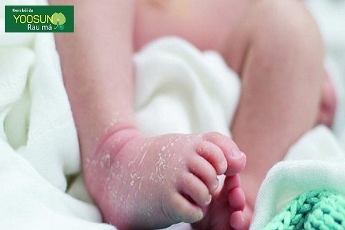 Tại sao trẻ sơ sinh bị tróc da tay chân