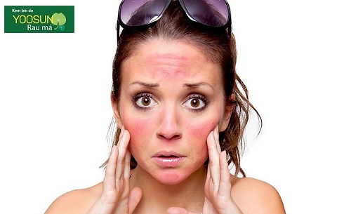 Bị dị ứng da mặt phải làm sao? Dấu hiệu và cách trị dị ứng mặt