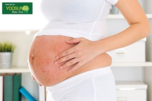 Dị ứng thai kỳ phải làm sao? Dấu hiệu và cách chữa dị ứng khi mang thai