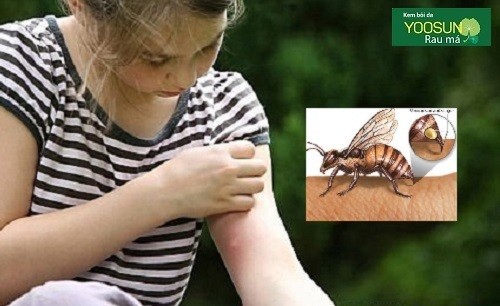 Dị ứng côn trùng đốt – Biểu hiện và cách chữa dị ứng với côn trùng
