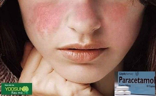 Dị ứng Paracetamol – Triệu chứng và cách chữa dị ứng thuốc Paracetamol