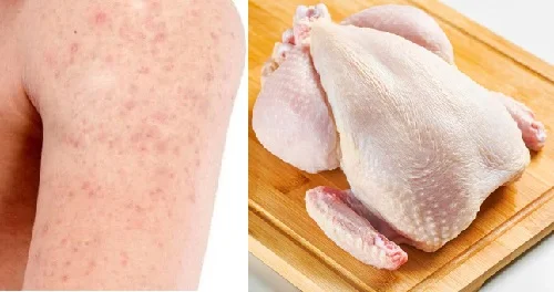Dị ứng thịt gà sau khi ăn: Thông tin cần biết để tránh hậu quả