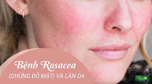 Bệnh Rosacea (chứng đỏ mặt): Nguyên nhân, dấu hiệu, điều trị