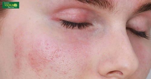 Bệnh nấm da mặt và cách điều trị