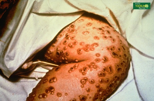 Bệnh đậu mùa là gì? Nguyên nhân, dấu hiệu và cách điều trị