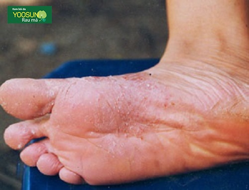 Bệnh nấm da chân là gì