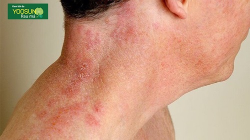Dấu hiệu nhận biết bệnh nấm da ở cổ trong cơ thể bạn giữ gìn sức khỏe