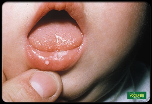 Bị nấm môi miệng: Nguyên nhân, biểu hiện, cách điều trị