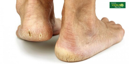 Cách chữa chai gót chân