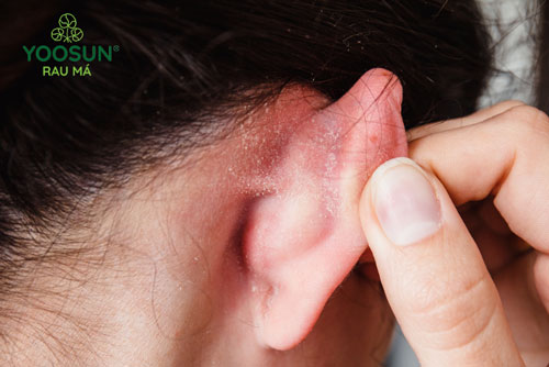 Bệnh viêm kẽ tai ở trẻ em là như thế nào