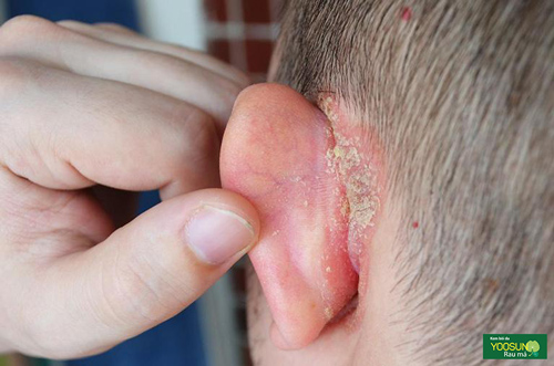 Trẻ bị hăm vành tai/Viêm kẽ tai: Biểu hiện và cách chữa trị