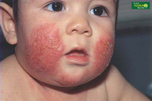 Bệnh chàm da mặt: Nguyên nhân, biểu hiện và cách điều trị