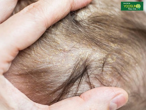 Bệnh chàm da đầu ở trẻ sơ sinh
