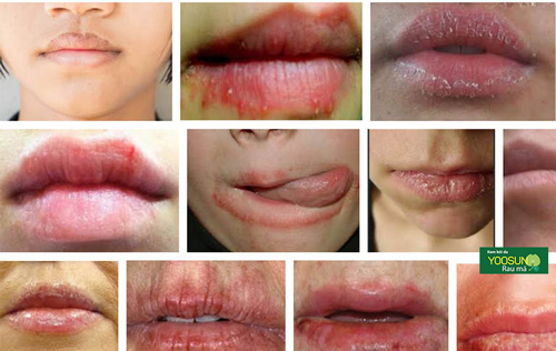 Dấu hiệu bệnh chàm môi là gì