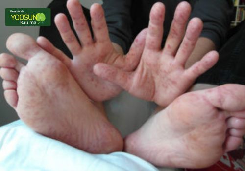 Bệnh tay chân miệng ở người lớn: nguyên nhân, biểu hiện và cách điều trị