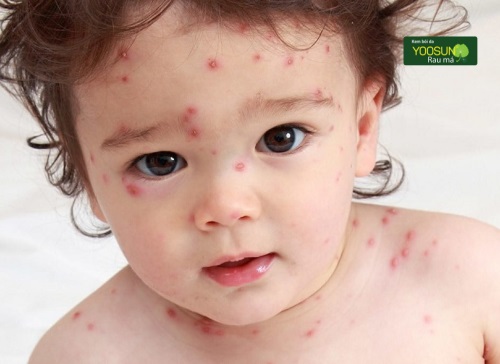 Cách xử lý bị nổi thủy đậu trên mặt tránh để lại di chứng