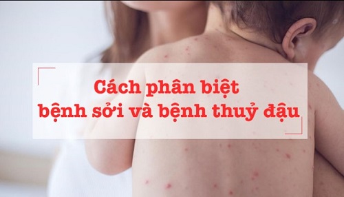 So sánh sởi và thủy đậu: Điểm giống nhau và khác nhau
