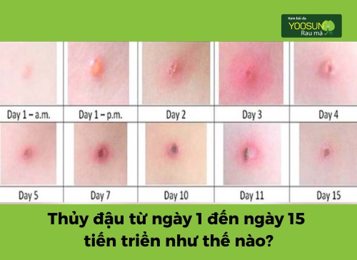 Tìm hiểu các giai đoạn bệnh thủy đậu: Hình ảnh, biểu hiện, xử lý