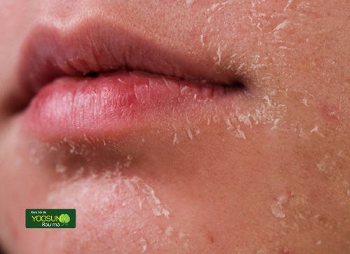 Bí quyết chăm sóc da khô quanh miệng dễ dàng thực hiện