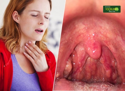 Thủy đậu mọc trong họng sao không? Nguyên nhân và xử lý