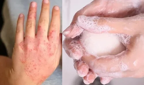 Dị ứng với Xà Phòng tắm, giặt: Dấu hiệu và cách xử lý