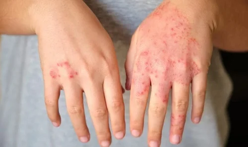 Tay dị ứng xà phòng