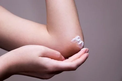 Bị dị ứng kem body phải làm sao