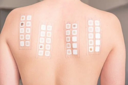 Cách trị dị ứng kem body