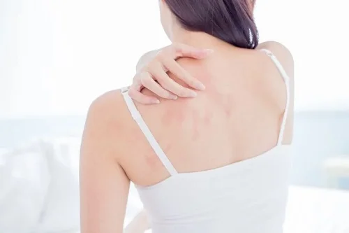 Dị ứng kem body: Nguyên nhân, biểu hiện và cách xử lý