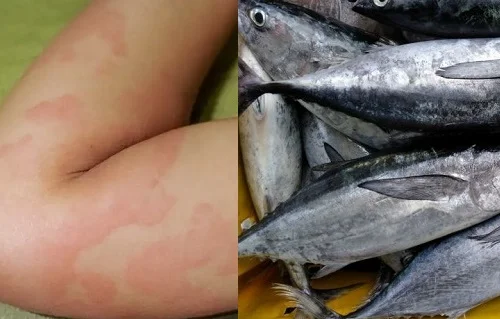 Dấu hiệu dị ứng cá ngừ 