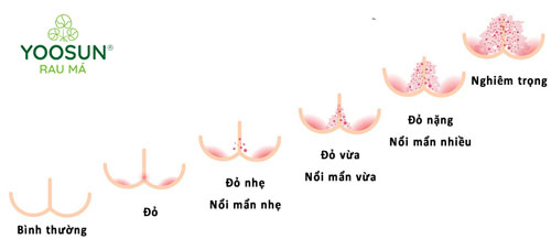 Triệu chứng hăm bỉm ở bé sơ sinh